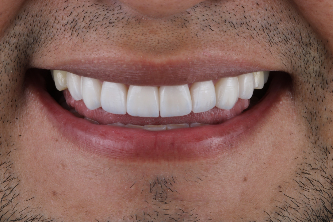 Carillas de porcelana