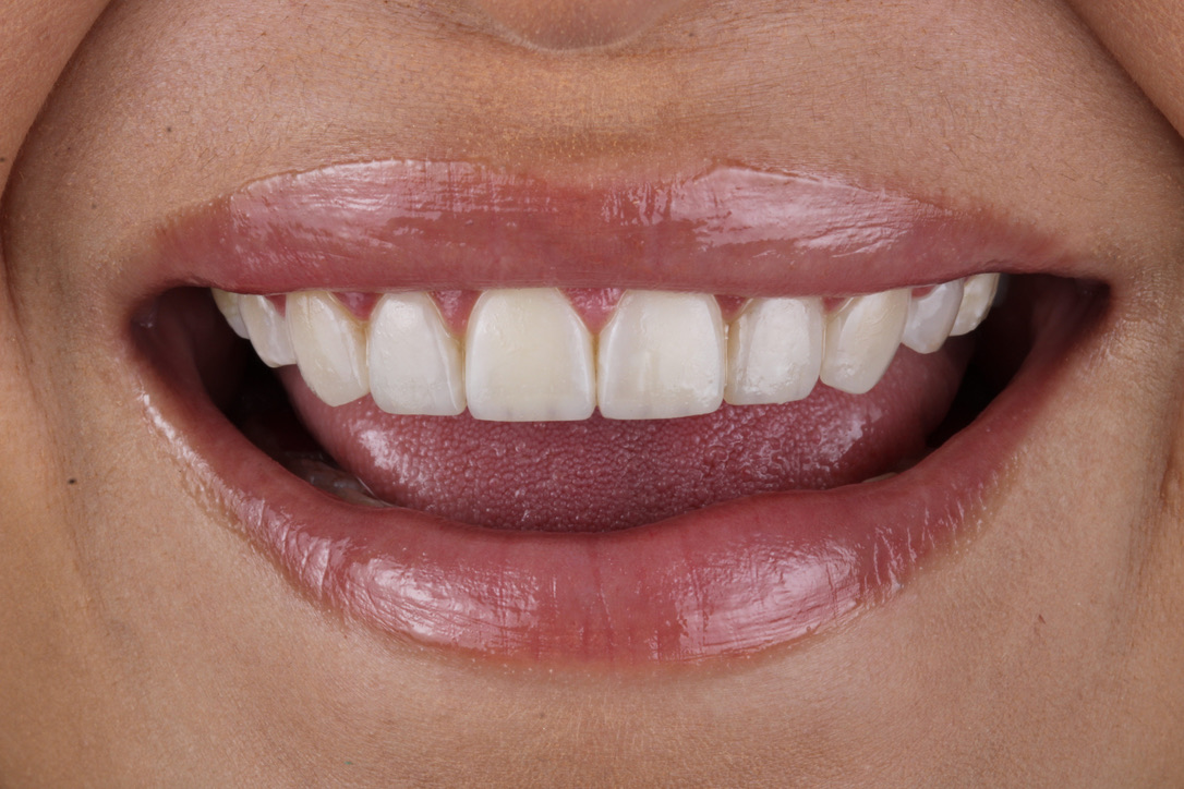 Carillas de resina directa