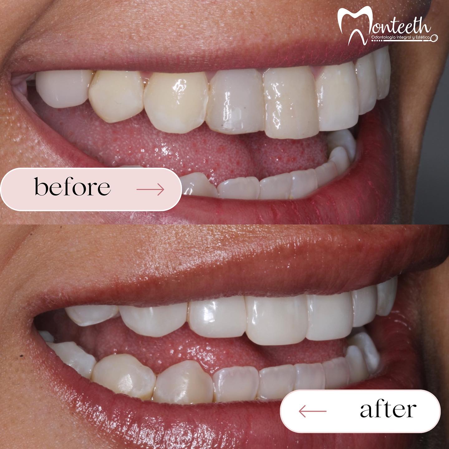 Diseño de Sonrisa - Carillas de Porcelana